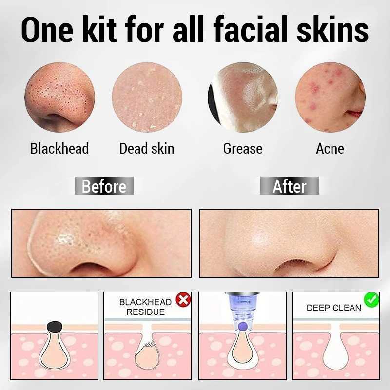 Electric Blackhead Remover – Pore Vacuum – view 3